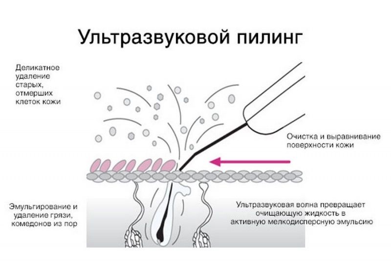 24411 Аппарат УЗ пилинга и УЗ терапии (фонофорез) Nova NewFace NV-233A (GT-233A) Nova NewFace (НОВА НьюФейс)  - Вид №2